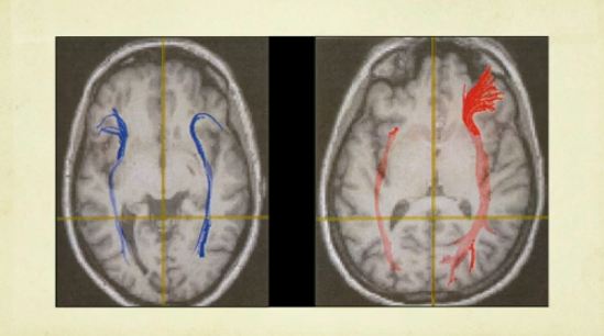 temple granding presenting her brain tensor imaging.1